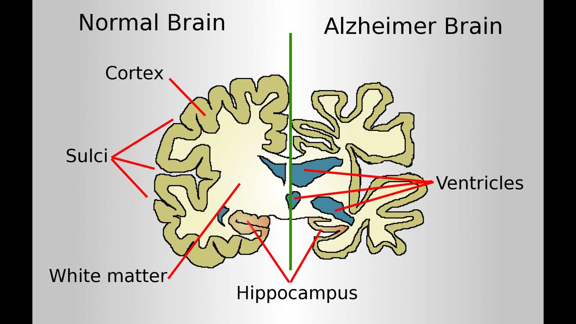 Alzheimer’s Research Can New Study Bring More Clarity Amidst the